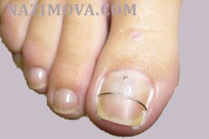 usl-laser-vrosshiy-nogot-sk.jpg usl-laser-vrosshiy-nogot-sk.jpg