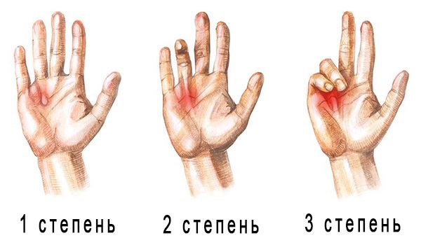 kontraktura1.jpg kontraktura1.jpg