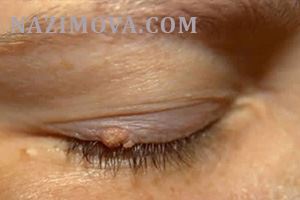 usl-laser-papilloma-veko.jpg usl-laser-papilloma-veko.jpg