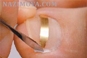 usl-laser-vrosshiy-nogot-pl.jpg usl-laser-vrosshiy-nogot-pl.jpg