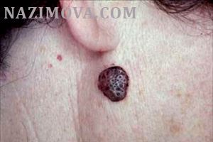 usl-laser-keratoma.jpg usl-laser-keratoma.jpg