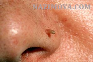 usl-laser-kojniy-rog2.jpg usl-laser-kojniy-rog2.jpg