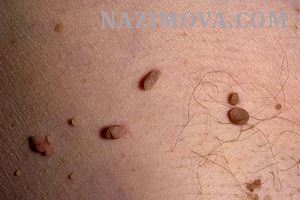 usl-laser-papilloma.jpg usl-laser-papilloma.jpg